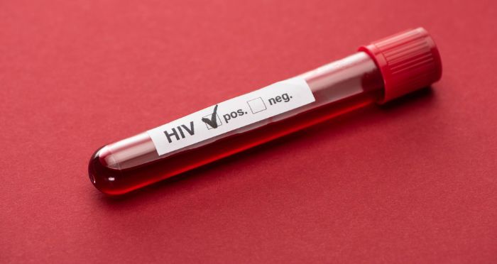 hiv aids 
